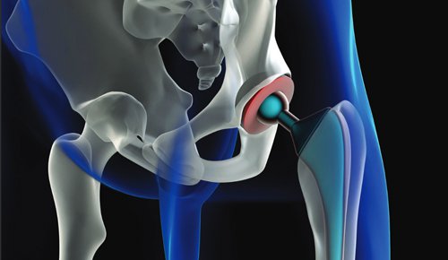 New Total Hip Replacement Precautions!